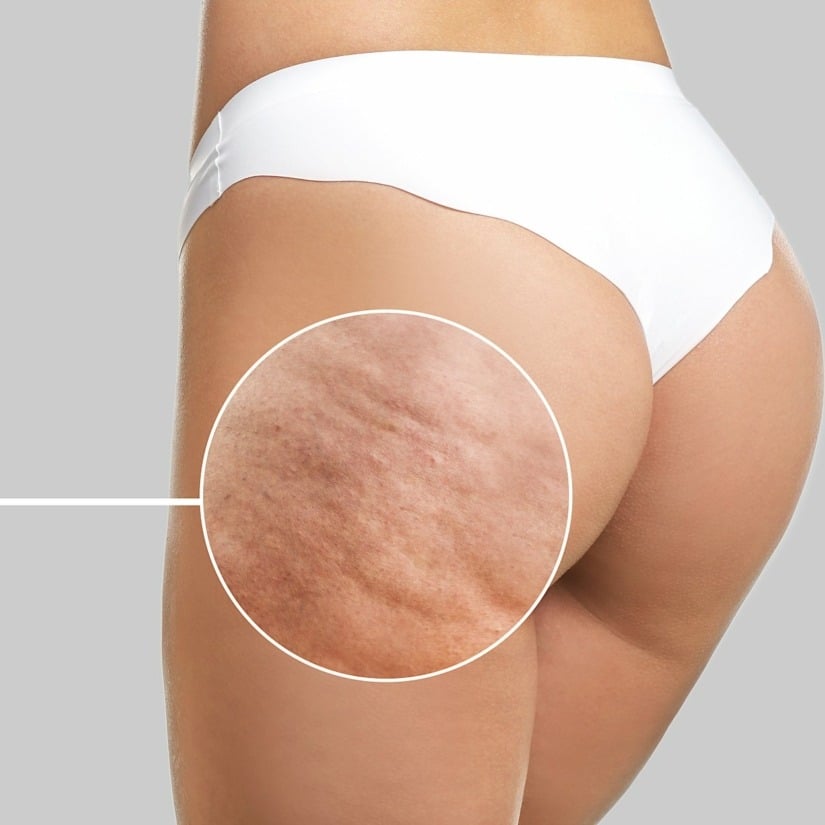 Jeune femme avec problème cellulite sur fond clair © Pixel-Shot/Shutterstock