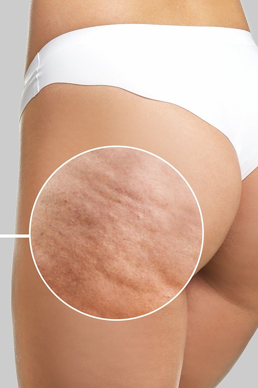 La cellulite aqueuse : c’est quoi et comment la reconnaître ?